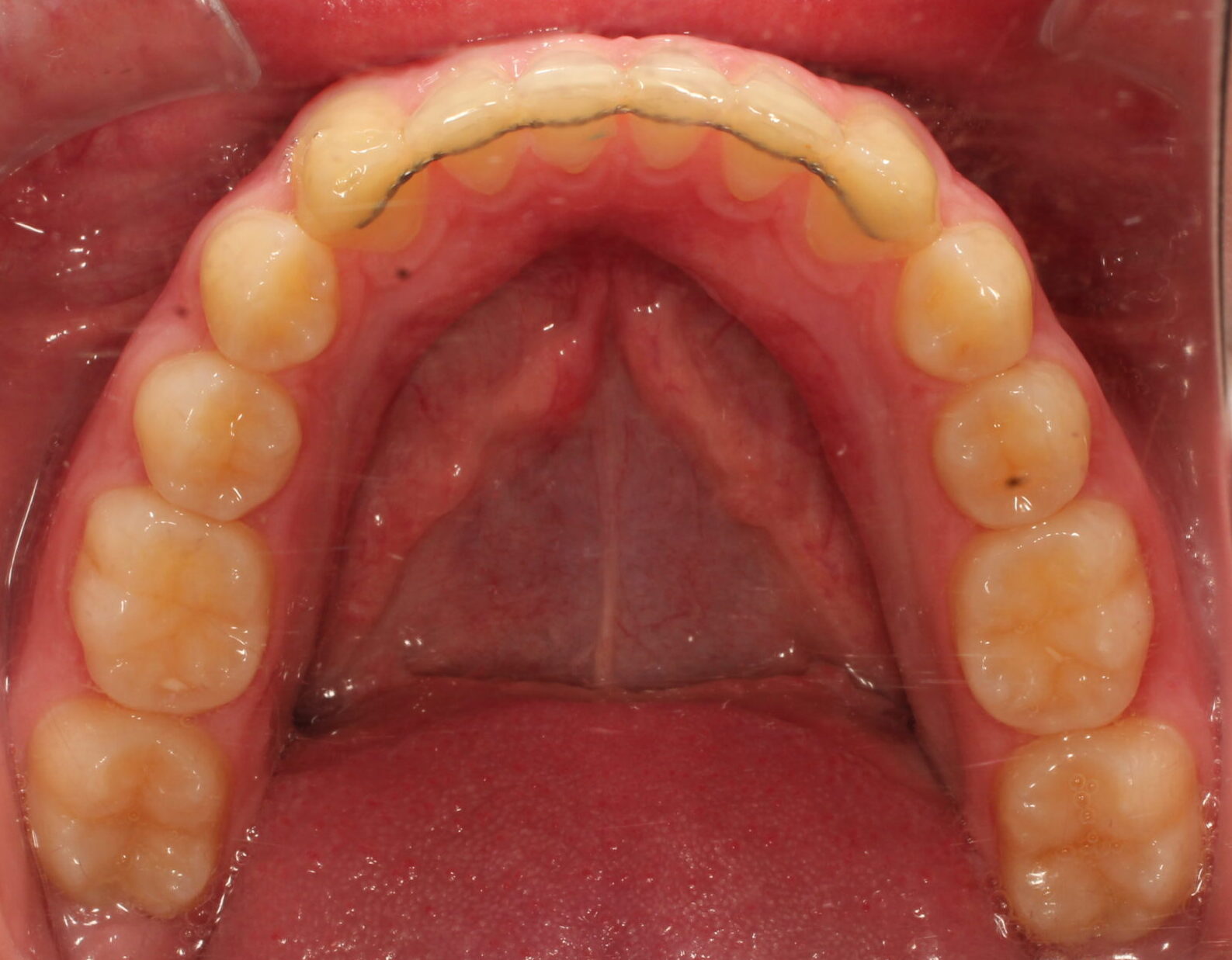 After braces lower teeth